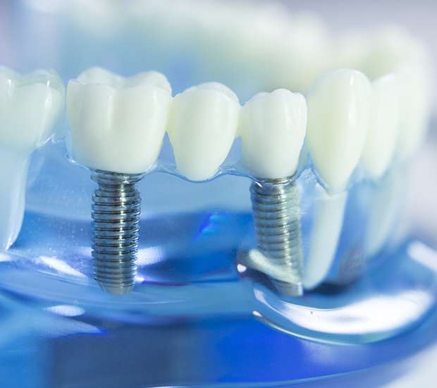 Carmichael Dental Implants
