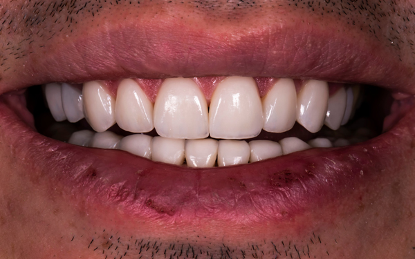 Dental Veneers Vs  Dentures: What Is The Difference?