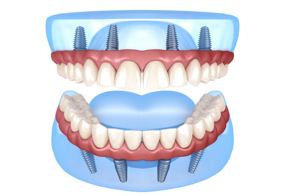 Tips To Extend The Longevity Of Implant Supported Dentures