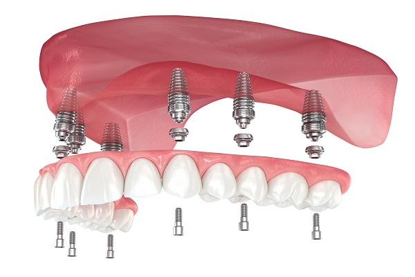 How Is The Implant Supported Dentures Procedure?